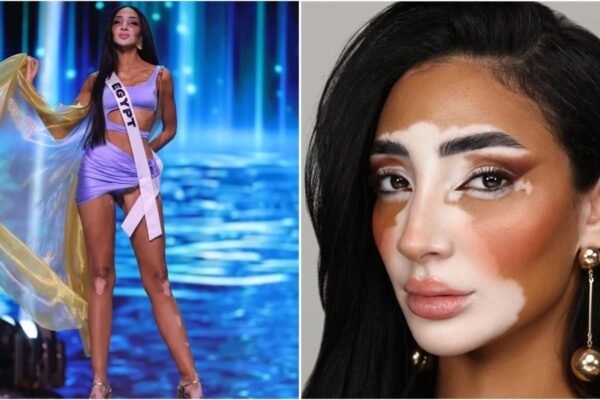Logina Salah entered the history of the contest “Miss Universe-2024” as the first participant with vitiligo: photo
