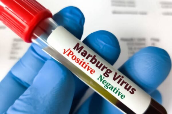 Marburg’s Disease: The Most Dangerous Bleeding Eye Disease Instills Fear: Find Out What It Is | – Times of India