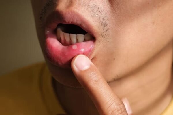 Do you often get ulcers in your mouth? A dentist shares what causes them and 4 simple ways to prevent it