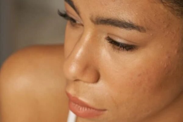 3 common skin slopes on face that are not acne – India’s times