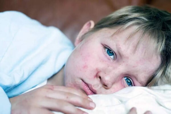 Measles for spreading worldwide? How to recognize symptoms and remain protected – India’s times
