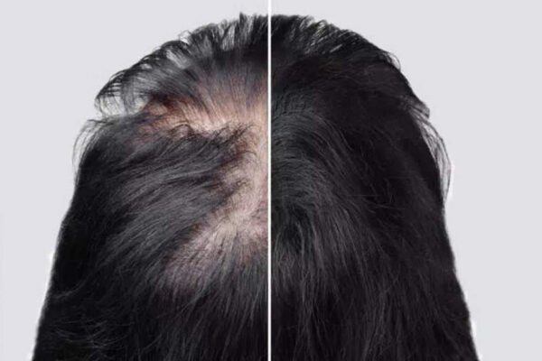 How to grow hair on bald spots using Amla – Times of India