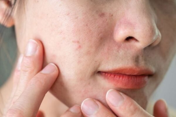 How to calm the irritated skin: 6 Major Expert Parade