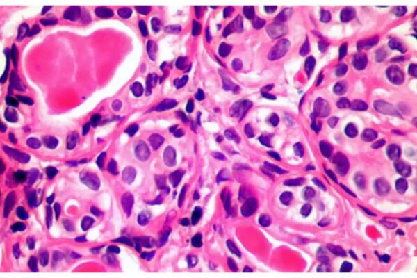 Can Pluton Leak Call Cancer? – India’s times