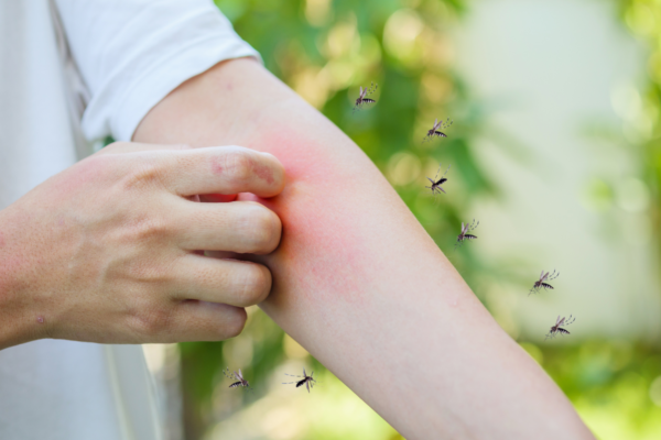 Itching, fever or worse? Can mosquito bites cause serious allergic reactions?