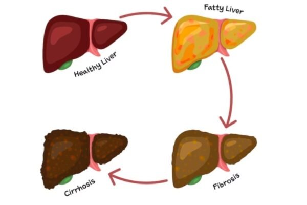 Harvard and Stanford, prepared by a gastroenterologist, reveals 3 worst drinks that can turn fat into cirrhosis “