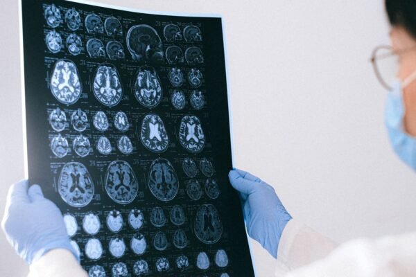 Is the vision blurred sign of a brain tumor? Surgeon shares 8 early warning characters you need to know
