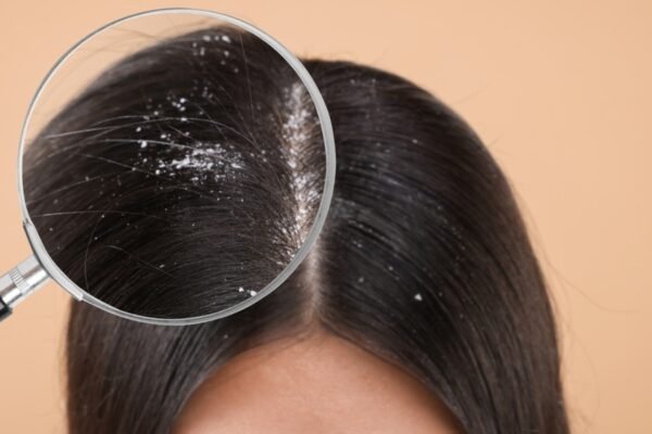 Dandruff or fungal infection? The doctor shares how to notice the difference