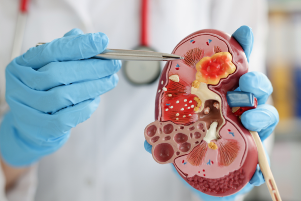 Symptoms of kidney cancer: 7 initial symptoms of kidney cancer that look harmless