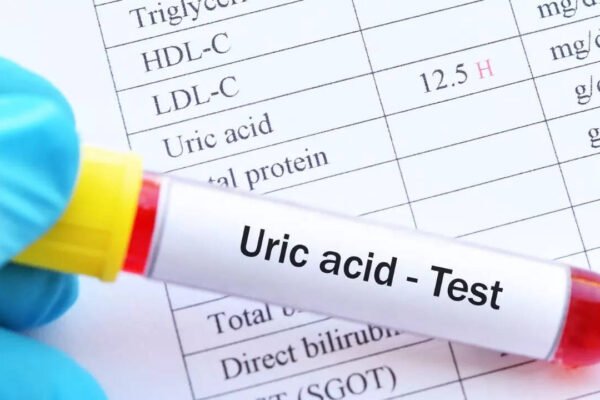 7 early signs of high uric acid in the body
