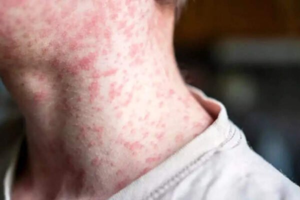 Flash of measles in the US: Causes, warning signs and how to prevent it | – India’s times