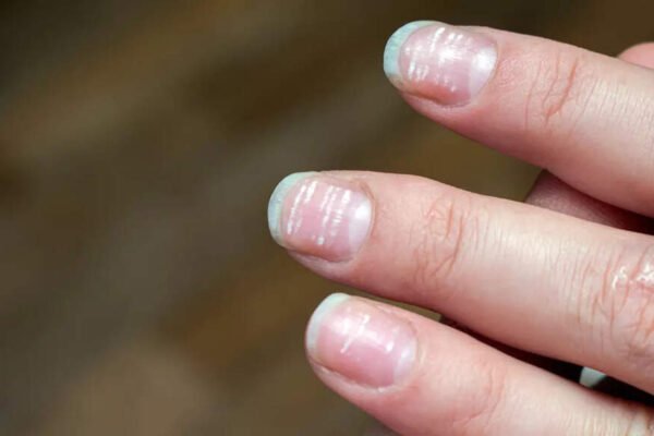 What are the tiny white spots on the nails? Best Functional Medicine DOC says it can be a pre -emptive sign | – India’s times
