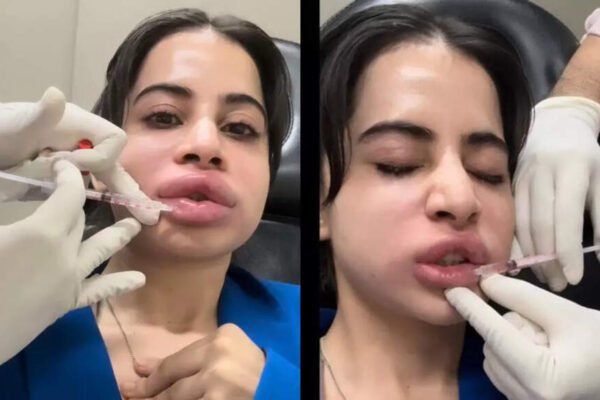 Lip fillers went wrong or ordinary side effect? Expert destroys swollen lips uorfi javed – Times of India