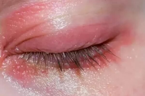 Rash around the eyes? It may be allergic, the doctor says; know the symptoms and 6 care tips