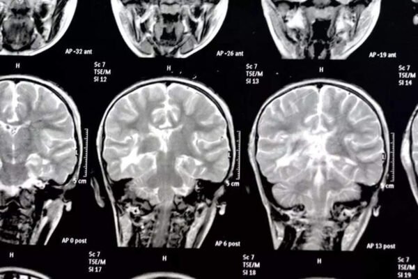 This silent threat around the brain is in the brain, even increasing the risk of dementia | – India’s times