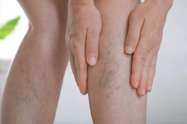 Are varicose veins a sign of poor blood circulation? That’s what you need to know | – India’s times