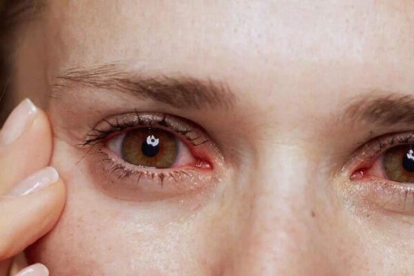 How to protect your eyes from infection with this monsoon: 10 effective tips | – India’s times