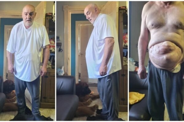 A 65-year-old man with a “football size” wins payments after trial when doctors rejected his symptoms as “bad back”