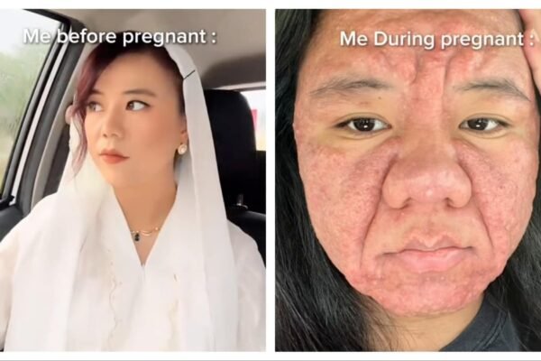 The woman shows the tough effect of pregnancy on her skin, the video receives 104 million views; The doctor explains that it caused